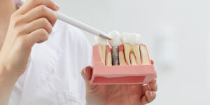 Implantologia Fissa a Capoterra