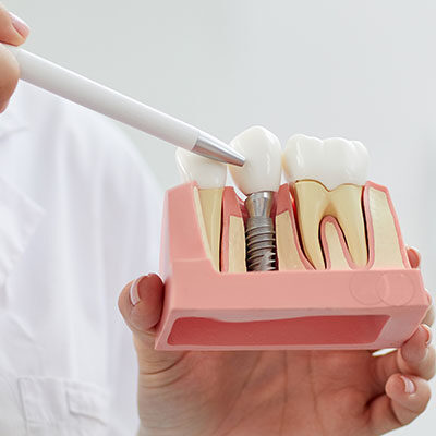 Implantologia Fissa a Capoterra