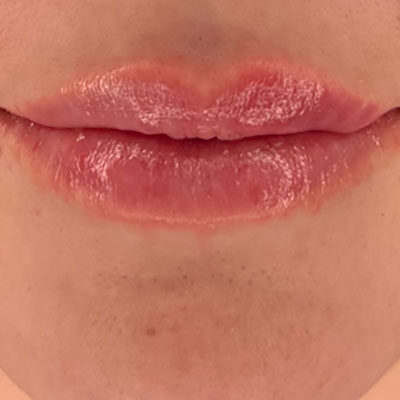 Medicina Estetica Filler Labbra Capoterra