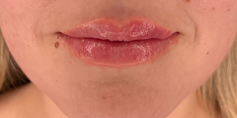 Medicina Estetica Filler Labbra Capoterra