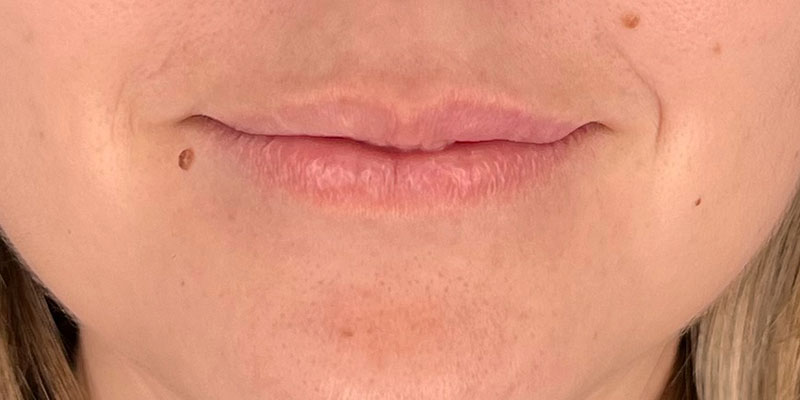 Medicina Estetica Fille Labbra Capoterra