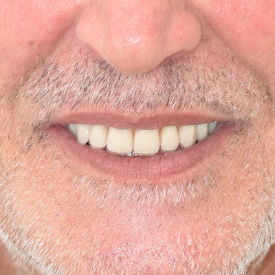 Implantologia Fissa con poco o senza osso a Capoterra