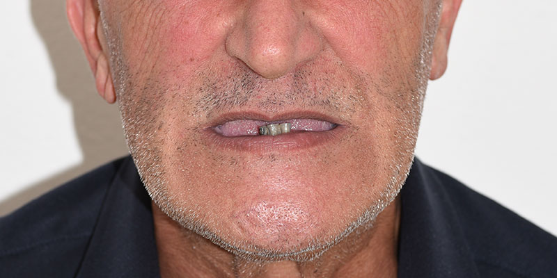 Implantologia Fissa con poco o senza osso a Capoterra