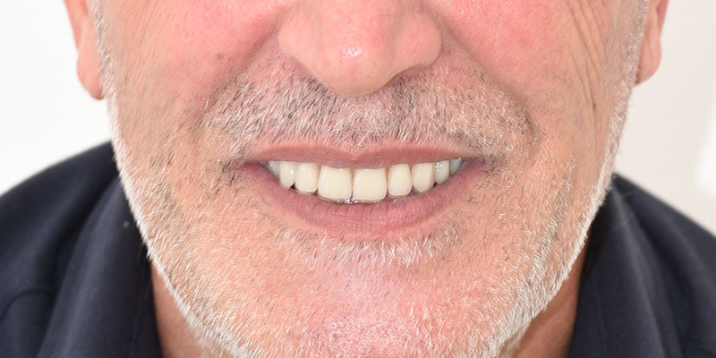 Implantologia Fissa con poco o senza osso a Capoterra