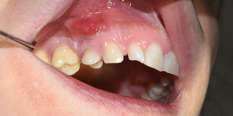 Ascesso Dentale